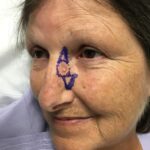 Cheek and nose wound reconstruction from skin cancer removal with Burow's Triangle Displacement flaps - Woman - Case 111213 - Preoperative - Oblique view