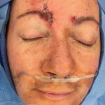 Forehead reconstruction from skin cancer removal with Burow's Triangle Displacement flap - Woman - Case 15410 - Intraoperative - Frontal view