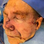Nose reconstruction from skin cancer removal with Bilobed Rotational flap - Man - Case 16501 - Intraoperative - Oblique view
