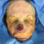 Nose reconstruction from skin cancer removal with Paramedian Forehead flap Miami- Woman - Case 16503 - Intraoperative - Frontal view