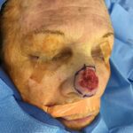Nose reconstruction from skin cancer removal with Paramedian Forehead flap Miami- Woman - Case 16503 - Intraoperative - Oblique view