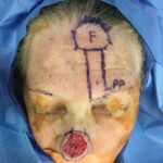 Nose reconstruction from skin cancer removal with Paramedian Forehead flap Miami- Woman - Case 16503 - Intraoperative - Frontal view