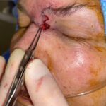 Nose reconstruction from skin cancer removal with Bilobed Rotational flap Miami- Woman - Case 16517 - Intraoperative - Oblique view