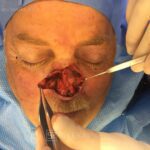 Nose reconstruction from skin cancer removal with Bilobed Rotational flap - Man - Case 16518 - Intraoperative - Frontal view