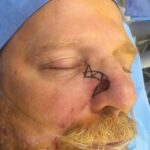 Nasal reconstruction from skin cancer removal with Bilobed Rotational flap - Man - Case 16535 - Intraoperative - Oblique view
