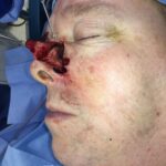 Nasal reconstruction from skin cancer removal with Bilobed Rotational flap - Man - Case 16532 - Intraoperative - Lateral view