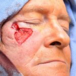 Cheek - lower eyelid wound reconstruction from skin cancer removal with Burow's Triangle Displacement Flap - Man - Case 111210 - Intraoperative - Oblique view
