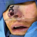 Nose reconstruction from skin cancer removal with Bilobed Rotational flap - Woman - Case 16514 - Intraoperative - Oblique view