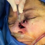 Nose reconstruction from skin cancer removal with Bilobed Rotational flap - Woman - Case 16516 - Intraoperative - Oblique view