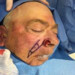 Nose reconstruction from skin cancer removal with Melolabial flap - Man - Case 16519 - Intraoperative - Oblique view
