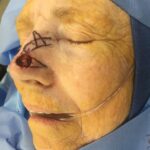 Nose reconstruction from skin cancer removal with Bilobed Rotational flap - Woman - Case 16521 - Intraoperative - Oblique view