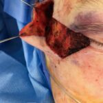 Cheek - lower eyelid wound reconstruction from skin cancer removal with Burow's Triangle Displacement Flap - Woman - Case 11129 - Intraoperative - Oblique view