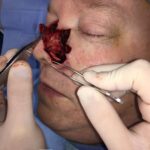 Nasal reconstruction from skin cancer removal with Bilobed Rotational flap - Man - Case 16532 - Intraoperative - Oblique view