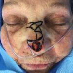 Nasal reconstruction from skin cancer removal with Bilobed Rotational flap - Woman - Case 16533 - After surgery - Frontal view