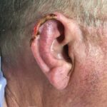 Right ear (helix) reconstruction from skin cancer removal with Post Auricular flap (2 stages) - Man - Case 17301 - Intraoperative - Lateral view