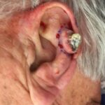 Left ear reconstruction from skin cancer removal (Cutaneous Horn)with Post Auricular flap (2 stages) - Man - Case 17302 - Intraoperative - Lateral view