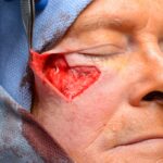 Cheek - lower eyelid wound reconstruction from skin cancer removal with Burow's Triangle Displacement Flap - Man - Case 111210 - Intraoperative - Oblique view