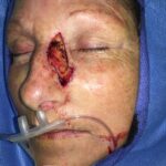 Cheek and nose wound reconstruction from skin cancer removal with Burow's Triangle Displacement flaps - Woman - Case 111213 - Intraoperative - Oblique view
