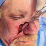 Cheek & Nose wound reconstruction from skin cancer removal with V-Y advancement flap - Man - Case 111218 - Intraoperative - Oblique view