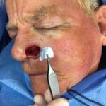 Nose reconstruction from skin cancer removal with Melolabial flap - Man - Case 16520 - Intraoperative - Oblique view