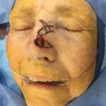 Nose reconstruction from skin cancer removal with Bilobed Rotational flap - Woman - Case 16521 - Intraoperative - Oblique view
