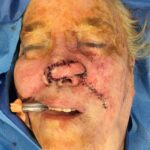 Nasal reconstruction from skin cancer removal with Melolabial flap - Woman - Case 16524 - Intraoperative - Frontal view