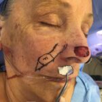 Nasal reconstruction from skin cancer removal with Melolabial flap - Woman - Case 16526 - Intraoperative - Oblique view