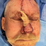 Nasal reconstruction from skin cancer removal with Paramedian Forehead flap - Man - Case 16529 - Intraoperative - Frontal view