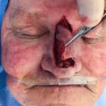 Nasal reconstruction from skin cancer removal with Dorsal Sliding Advancement flap - Man - Case 16530 - Intraoperative - Frontal view