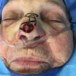 Nasal reconstruction from skin cancer removal with Bilobed Rotational flap - Woman - Case 16533 - After surgery - Frontal view