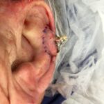 Left ear reconstruction from skin cancer removal (Cutaneous Horn)with Post Auricular flap (2 stages) - Man - Case 17302 -Intraoperative - Lateral view