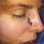 Cheek wound reconstruction from skin cancer removal with Burow's Triangle Displacement flaps - Woman - Case 111212 - Intraoperative - Lateral view