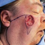 Cheek wound reconstruction from skin cancer removal with Cervicofacial flap - Man - Case 111214 - Intraoperative - Lateral view