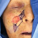 Cheek wound reconstruction from skin cancer removal with Burow's Triangle Displacement flaps - Woman - Case 11124 - Before and after - Frontal view