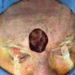 Forehead reconstruction from skin cancer removal with A-T Advancement flaps - Man - Case 15401 - Intraoperative - Frontal view
