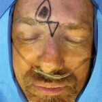 Forehead reconstruction from melanocitic patch removal with Burow's Triangle Displacement flap - Man - Case 15407 - Intraoperative - Frontal view