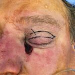 Left medial lower eyelid reconstruction from skin cancer removal with Upper to Lower eyelid switch pedicle flap (2 stages) - Man - Case 15411 - Intraoperative - Oblique view