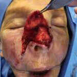 Nose reconstruction from skin cancer removal with Burow's Triangle Displacement flap - Woman - Case 16515 - Intraoperative - Frontal view