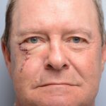 Cheek - lower eyelid wound reconstruction from skin cancer removal with Burow's Triangle Displacement Flap - Man - Case 111210 - Postoperative - Frontal view