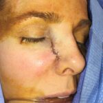 Cheek wound reconstruction from skin cancer removal with Burow's Triangle Displacement flaps - Woman - Case 111212 - Postoperative - Oblique view