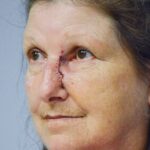 Cheek and nose wound reconstruction from skin cancer removal with Burow's Triangle Displacement flaps - Woman - Case 111213 - Postoperative - Oblique view