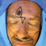 Forehead reconstruction from melanocitic patch removal with Burow's Triangle Displacement flap - Man - Case 15407 - Intraoperative - Frontal view