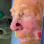 Nose reconstruction from skin cancer removal with Bilobed Rotational flap - Man - Case 16506 - Intraoperative - Oblique view
