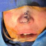 Nose reconstruction from skin cancer removal with Bilobed Rotational flap - Woman - Case 16514 - Intraoperative - Frontal view