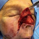 Nose reconstruction from skin cancer removal with Burow's Triangle Displacement flap - Woman - Case 16515 - Intraoperative - Oblique view