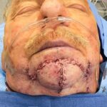 Chin wound reconstruction from skin cancer removal with bilateral Advancement flaps (A-T flaps) - Man - Case 11125 - Before and after - Inferior view