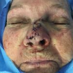 Nasal reconstruction from skin cancer removal with Bilobed Rotational flap - Woman - Case 16533 - Intraoperative - Frontal view