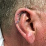 Right ear (helix) reconstruction from skin cancer removal with Post Auricular flap (2 stages) - Man - Case 17301 - Intraoperative - Lateral view