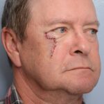 Cheek - lower eyelid wound reconstruction from skin cancer removal with Burow's Triangle Displacement Flap - Man - Case 111210 - Postoperative- Oblique view