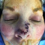 Nose reconstruction from skin cancer removal with Bilobed Rotational flap - Woman - Case 16505 - Intraoperative - Frontal view